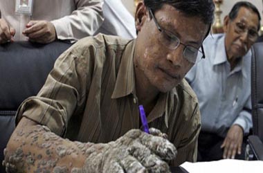 الرجل الشجرة يخضع لتاسع جراحة لإزالة زوائد جذعية