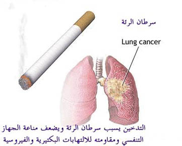 اختصاصي أمراض قلبية: 70 بالمائة من ضحايا الجلطة في الأردن من المدخنين