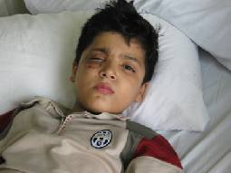 طفل يفقد إحدى عينيه في السلط بسبب عبثية وعدوانية اطفال