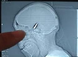 رصاصة في رأس وافد مصري تبقى شهرين دون الإحساس بها