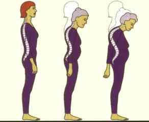 30% من النساء الاردنيات مصابات بهشاشة العظام