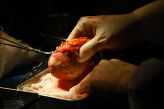 130 حالة..أردنيون يواجهون الفقر والبطالة بـ"بيع الكُلى" مقابل 5000 دولار