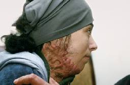 حروق من الدرجة الثالثة تجعل من المرايا عدوا لدودا لـ"ندى"