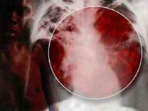 أردنية تتسبب بوفاة زوجها الأول والثاني وإصابة 3 رجال و3 من أطفالها بمرض السل!!