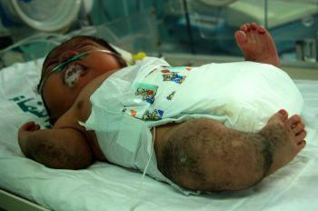 بسبب الفسفور الأبيض.. طفل على هيئة غوريلا بتشوهات شديدة في جسده بقطاع غزة