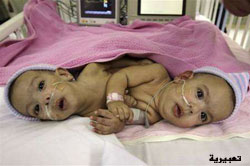 سيدة تضع توأمين ملتصقين من جهة البطن في مستشفى الزرقاء الحكومي