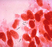 دراسة حكومية: 33% من الأطفال يحملون بكتيريا المكورات الرئوية