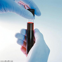 انخفاض اعداد الاصابات الجديدة بالثلاسيميا الى 25 حالة سنويا