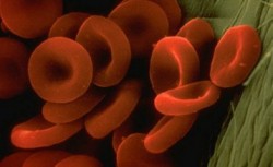 دراسة طبية تكشف عن 40 اصابة بمرض وراثي نادر "التبول الاسود"  بالكرك