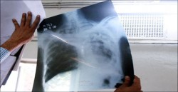 تسجيل 336 حالة مصابة بمرض السل منها 104 بين الوافدين العام الماضي