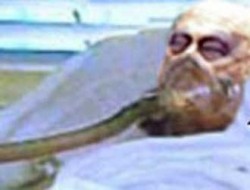 أمعاء شارون تصاب بالعفن والغرغرينا .. والأطباء يستأصلونها