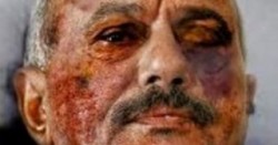 انتشار صورة للرئيس اليمني تظهر وجهه محروقاً