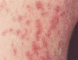 اشتباه باصابة 10 ممرضات بـ«التيفوئيد» في مركز صحي الربة