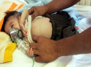 طفل بقلب مشوه يقرر الأطباء إكمال علاجه في البيت