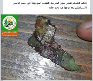 القسام تنشر شريحة التعقب بعد نزعها من تحت جلد شاؤول