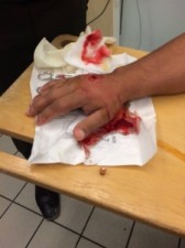 بالصورة...اصابة رجل برصاصة طائشة اخترقت يده وهو جالس فوق سطح بيته في المقابلين