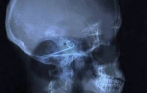 استخراج مقص اخترق انف وجمجمة طفلة في مستشفى حمزة