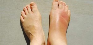 لا تتجاهلوا تورم القدمين .. قد تكونوا مصابون بهذه الأمراض الخطيرة!