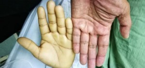 ثلث الأطفال في الأردن یعانون من فقر الدم