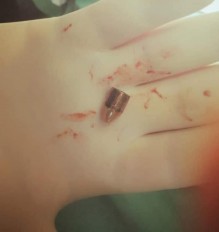 بالصور ... إصابة طفلة بعيار ناري طائش في قرية برما بجرش