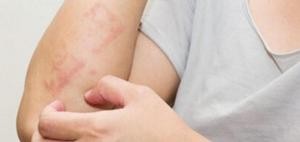 35 % من سكان المملكة يعانون الحساسية