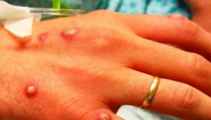 الإمارات تعلن تسجيل 3 حالات جديدة لـ جدري القرود