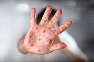 فاوتشي: يجب أخذ جدري القردة على محمل الجد