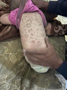 حماية الاسرة تصل للأطفال الذي جرى تداول صورهم وتظهر عليهم صور الإهمال والمرض